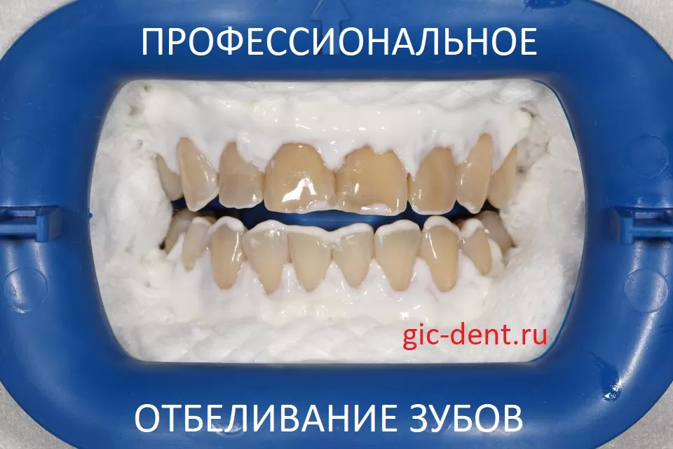 Профессиональной отбеливание зубов в Немецком имплантологическом центре